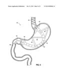 STOMACH-SPANNING GASTRIC IMPLANTS diagram and image