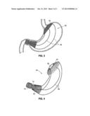 STOMACH-SPANNING GASTRIC IMPLANTS diagram and image