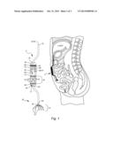 IMPLANTABLE BIOARTIFICIAL PERFUSION SYSTEM diagram and image