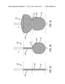 Valvuloplasty Catheter diagram and image