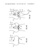 Valvuloplasty Catheter diagram and image