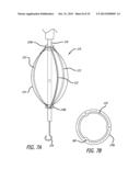 Valvuloplasty Catheter diagram and image