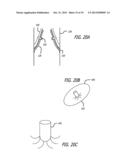 Valvuloplasty Catheter diagram and image