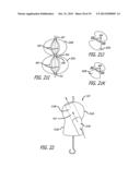 Valvuloplasty Catheter diagram and image