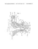 IMPLANTABLE ACOUSTIC SENSOR diagram and image