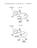 IMPLANTABLE ACOUSTIC SENSOR diagram and image