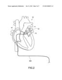 LASER THERAPY APPARATUS, LASER THERAPY SYSTEM, AND DETERMINATION METHOD diagram and image