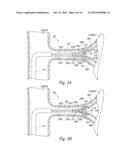 CATHETER ASSEMBLIES FOR NEUROMODULATION PROXIMATE A BIFURCATION OF A RENAL     ARTERY AND ASSOCIATED SYSTEMS AND METHODS diagram and image