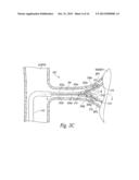 CATHETER ASSEMBLIES FOR NEUROMODULATION PROXIMATE A BIFURCATION OF A RENAL     ARTERY AND ASSOCIATED SYSTEMS AND METHODS diagram and image