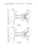 CATHETER ASSEMBLIES FOR NEUROMODULATION PROXIMATE A BIFURCATION OF A RENAL     ARTERY AND ASSOCIATED SYSTEMS AND METHODS diagram and image