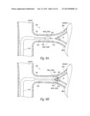 CATHETER ASSEMBLIES FOR NEUROMODULATION PROXIMATE A BIFURCATION OF A RENAL     ARTERY AND ASSOCIATED SYSTEMS AND METHODS diagram and image