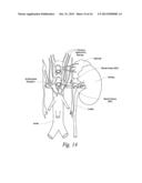 CATHETER ASSEMBLIES FOR NEUROMODULATION PROXIMATE A BIFURCATION OF A RENAL     ARTERY AND ASSOCIATED SYSTEMS AND METHODS diagram and image