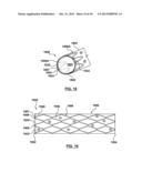 RING ON A CLOSED WEB STENT-GRAFT FOR USE IN TIP CAPTURE diagram and image