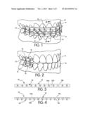 SINGER-DOMANSKI RESIN MMF/REIMPLANTATION DEVICE diagram and image