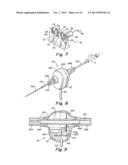 Apparatus and Methods for Low-Cost Intravascular Ultrasound Imaging and     for Crossing Severe Vascular Occlusions diagram and image