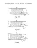 Apparatus and Methods for Low-Cost Intravascular Ultrasound Imaging and     for Crossing Severe Vascular Occlusions diagram and image