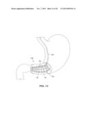 SATIATION DEVICES AND METHODS diagram and image