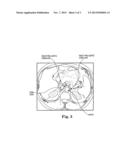 SYSTEM AND METHOD OF PRE-AORTIC GANGLION ABLATION diagram and image