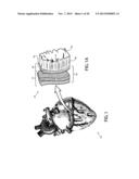 DEVICES, SYSTEMS, AND METHODS FOR TREATING CARDIAC ARRHYTHMIAS diagram and image
