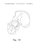 RECIPROCATING RASPS FOR USE IN AN ORTHOPAEDIC SURGICAL PROCEDURE diagram and image