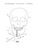 Surgical Guide with Cut Resistant Inserts diagram and image