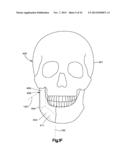 Surgical Guide with Cut Resistant Inserts diagram and image