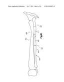 Surgical Guide with Cut Resistant Inserts diagram and image