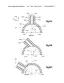 Surgical Guide with Cut Resistant Inserts diagram and image