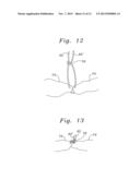 SINGLE CATHETER HEART REPAIR DEVICE AND METHOD FOR USE diagram and image