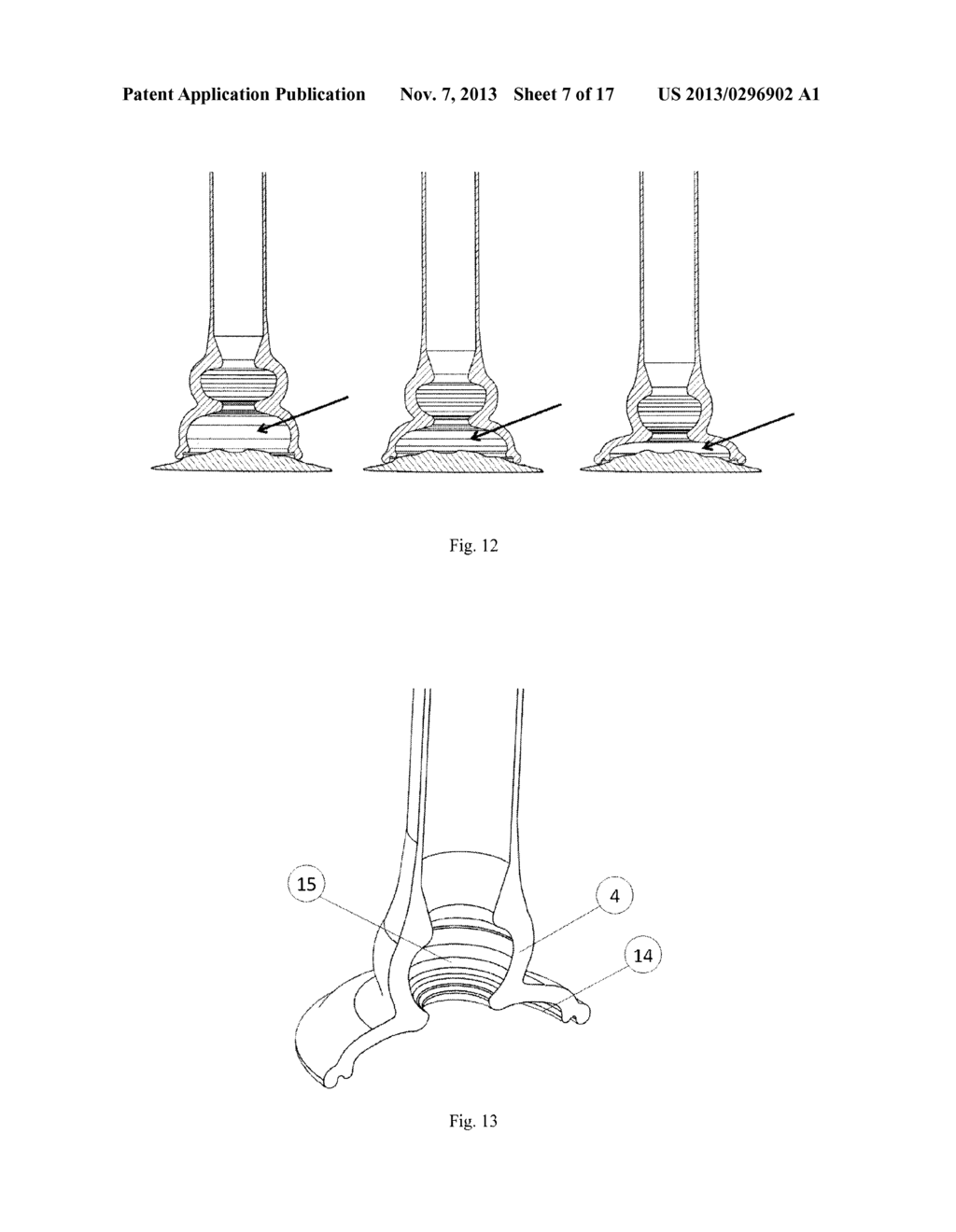 VACUUM ANCHORING CATHETER - diagram, schematic, and image 08