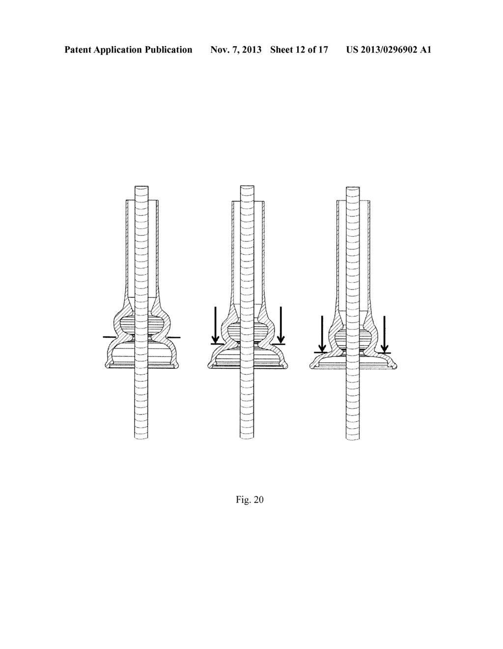 VACUUM ANCHORING CATHETER - diagram, schematic, and image 13