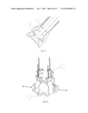 VACUUM ANCHORING CATHETER diagram and image