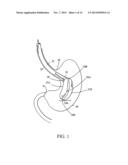 INTRAGASTRIC SPACE FILLER diagram and image