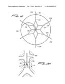 VEIN FILTER diagram and image