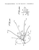 VEIN FILTER diagram and image