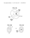 PATENT FORAMEN OVALE CLOSURE DEVICE diagram and image