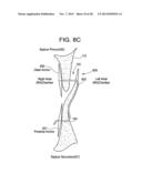 PATENT FORAMEN OVALE CLOSURE DEVICE diagram and image