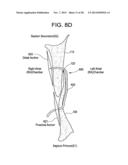 PATENT FORAMEN OVALE CLOSURE DEVICE diagram and image