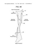 PATENT FORAMEN OVALE CLOSURE DEVICE diagram and image