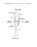 PATENT FORAMEN OVALE CLOSURE DEVICE diagram and image