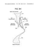 PATENT FORAMEN OVALE CLOSURE DEVICE diagram and image