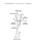 PATENT FORAMEN OVALE CLOSURE DEVICE diagram and image