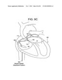 PATENT FORAMEN OVALE CLOSURE DEVICE diagram and image