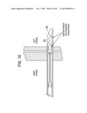 PATENT FORAMEN OVALE CLOSURE DEVICE diagram and image