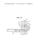 PATENT FORAMEN OVALE CLOSURE DEVICE diagram and image