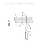 PATENT FORAMEN OVALE CLOSURE DEVICE diagram and image