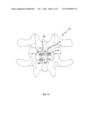 ADJUSTABLE SPINOUS PROCESS SPACER DEVICE AND METHOD OF TREATING SPINAL     DISORDERS diagram and image