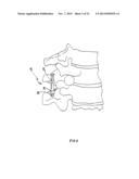ADJUSTABLE SPINOUS PROCESS SPACER DEVICE AND METHOD OF TREATING SPINAL     DISORDERS diagram and image