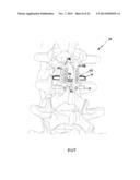 ADJUSTABLE SPINOUS PROCESS SPACER DEVICE AND METHOD OF TREATING SPINAL     DISORDERS diagram and image