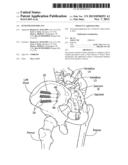 FENESTRATED IMPLANT diagram and image